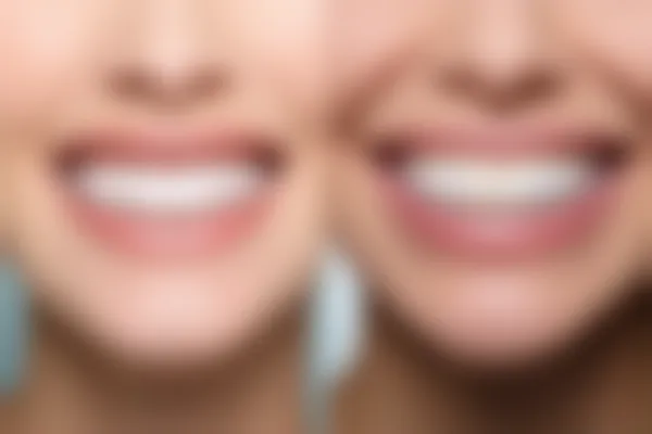 辽宁营口西市瑞宁口腔洗牙原价388元起，现限时优惠仅需288元起，机会难得，赶快行动！