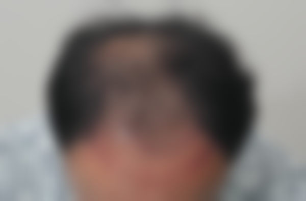 韩国JJ毛发移植医院特色诊疗项目与技术优势