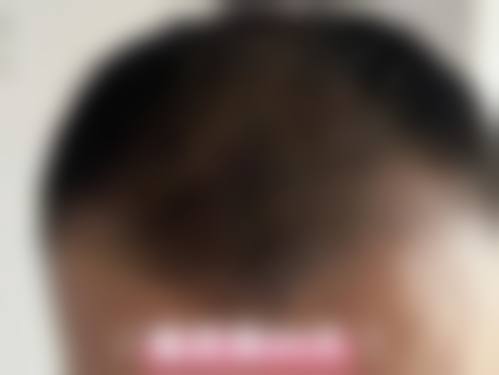 合肥碧莲盛植发预约挂号方式