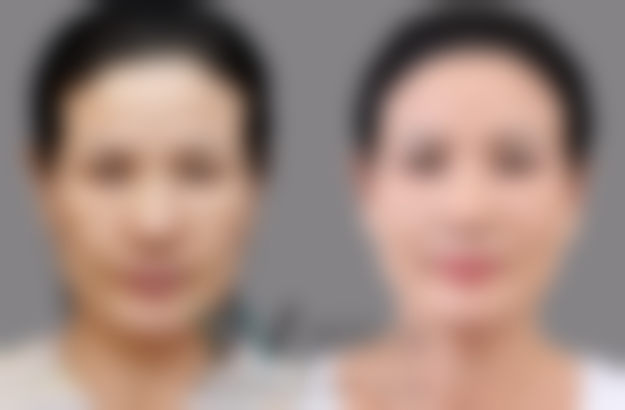 韩国原辰整形外科医院收费价格表