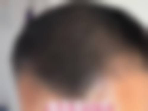 西安交大二附院植发科收费价格表