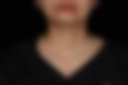 优惠活动详情:光子嫩肤限时特别优惠